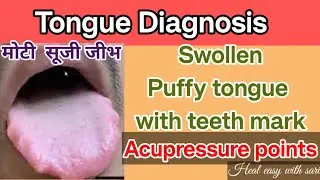 SWOLLEN AND PUFFY TONGUE WITH TEETH MARKS? | TRY THIS SIMPLE REMEDY AT HOME | HEAL EASY WITH SARI