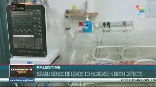 Israeli genocide leads to increase in birth defects