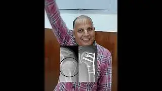 #fractureshoulder #platingshoulder #besttraumasurgeon #Philosplating #titaniumplate#dramitaggrawal