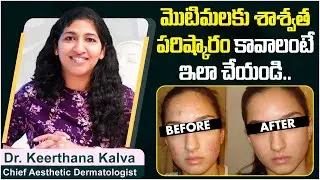 Best Acne Treatment for Clear Skin | Effective Treatment for Pimples | Inform Skin Clinic