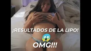 Vlog 5: Día 7 - ¡Primer baño en una semana y vemos la liposucción por primera vez y  nuevos masajes!