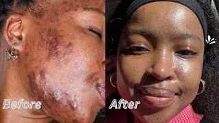 MY ACNE JOURNEY|How I cleared my hormonal & cystic acne | South African YouTuber