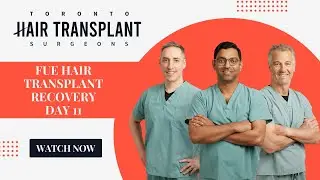 FUE Hair Transplant Recovery | Day 11