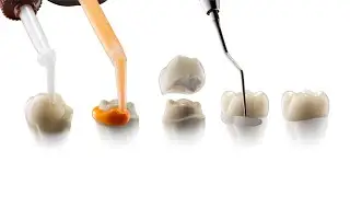 Single-Unit Crown Workflow Solutions&trade; Final Impression Procedure