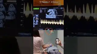 9 Weeks Baby Normal Heart Beat showing healthy pregnancy