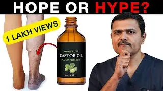 CASTOR OIL for Varicose Veins? All you wanted to know!