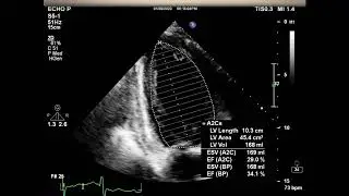 [Echo Case Review] RWMA, Valve disease