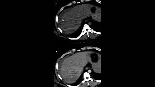 Post traumatic AAST Grade 2 liver laceration with sentinel clot sign