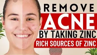 Amazing Benefits Of Zinc | Zinc For Acne Before And After