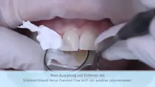 Die anspruchsvolle Klasse IV Restauration    Einfach und sch&ouml;n mit Venus Diamond DE