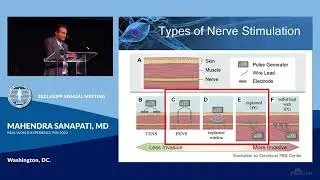 Real World Experience of Peripheral Nerve Stimulation