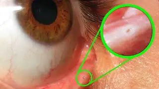 How Long Have You Known About hole in Lid