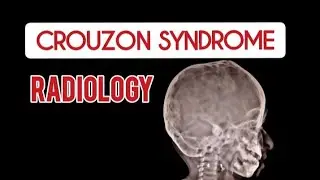 CROUZON SYNDROME - Skull X Ray - Radiology