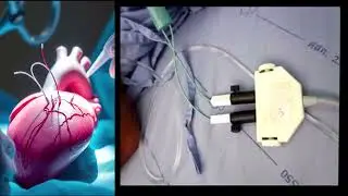 temporary pacemaker part 5 epicardial pacemaker