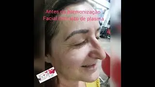 Antes e depois do Jato de Plasma