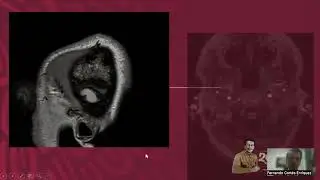 Deterioro cognitivo en la esclerosis múltiple
