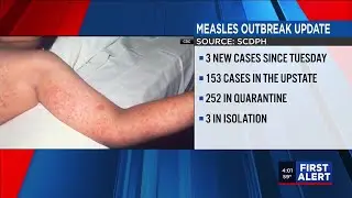DPH reports three new cases in Upstate measles outbreak