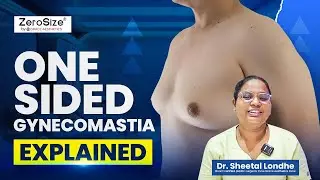 One‑Sided Gynecomastia Explained