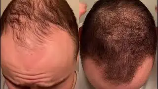 22 month hair journey (from bald to full head of hair)