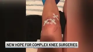 Back in the game: New hope for complex knee surgeries - clipped version