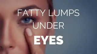 Fatty lumps under eyes and how to treat them......Fast!!!