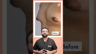 Before & After Gynecomastia Surgery | Post Gynecomastia Surgery Scar | #shorts