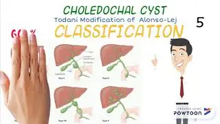 Choledochal Cyst in 1 minute