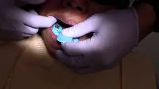 Dental Implant - Open Tray Impression Technique  - How to