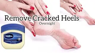 Remove Cracked Heels Overnight | یہ ویزلین پھٹی ایڑیوں کو بناۓ خوبصورت | Get Soft & Beautiful Heels