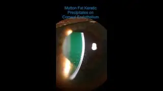 Intermediate Uveitis - Vitritis & Mutton Fat KPs