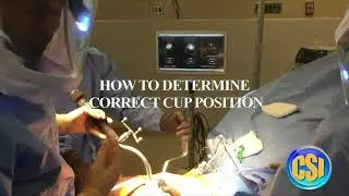 #orthopedics  🟢 Computer-Assisted Mini-Posterior Hip Replacement / Precise Cup Placement~