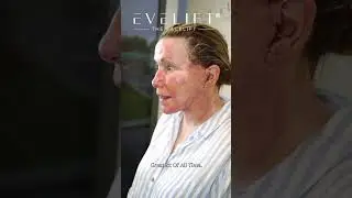 Heather's EVE Lift&trade; Reveal | Eden Plastic Surgery: Dr. Ali Charafeddine, MD
