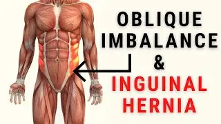 Oblique Muscle Imbalance & Inguinal Hernias