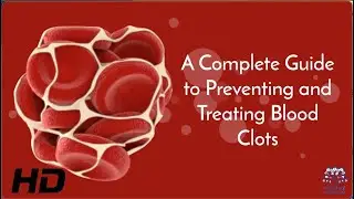 From Awareness to Action: Safeguarding Against Blood Clots