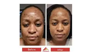 Non-Invasive Skin Procedures With Results Achieved