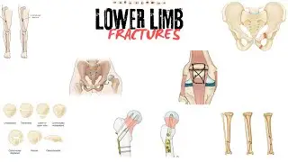 LOWER LIMB FRACTURES ,CLASSIFITION  AND  MANAGEMENT #orthopedics #surgeryreview  #shamim #dogar