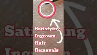 Tweezing ingrowing hairs