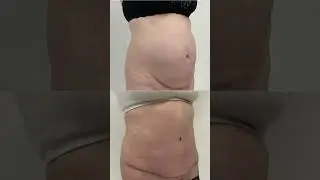 Tummy tuck with muscle repair (no liposuction) - Before & After 😍
