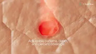 UltraClear® Laser Coring™ Animation