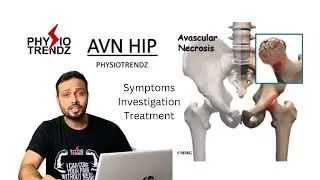 AVN Hip, Symptoms, Investigation, Treatment |Physiotherapy |Physiotrendz