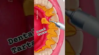 DENTAL TARTAR