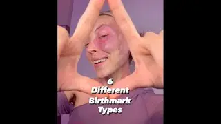 6 Different Birthmark Types