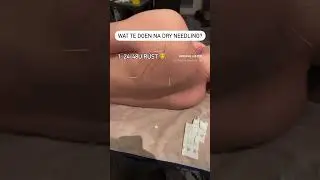 Dry needling?