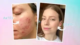 Qual &eacute; o melhor &aacute;cido para manchas p&oacute;s acne?