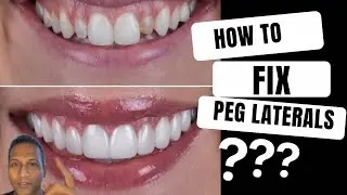 How to fix Peg Laterals - Dr. Patel explains