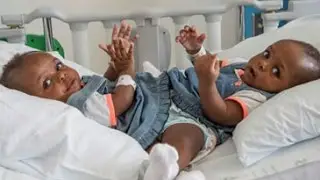 Conjoined twins from Nigeria successfully separated at a Tennessee hospital
