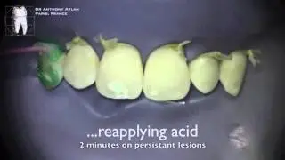 White spots on enamel treatment by Erosion Infiltration without any bur