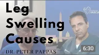 Leg Swelling Causes Explained by Dr. Peter Pappas