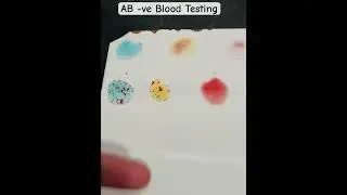 AB Negative Blood Group| ABO Typing|  #bloodgroup #abobloodgroup #hospitallife #shortsfeed #shorts