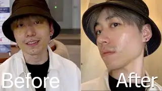 Non Invasive Cell Therapy skin treatment | Seoul Guide Medical